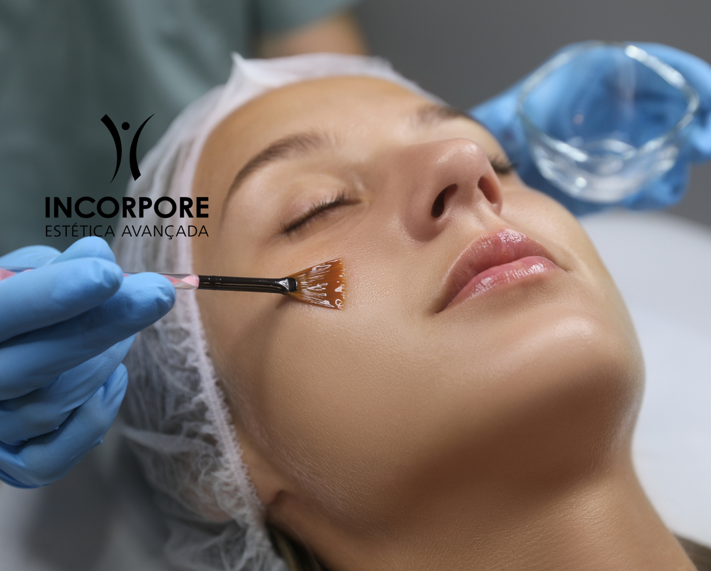 Tipos de Manchas: Melasma, Sardas e Hiperpigmentação Pós-Inflamatória - inspiração 2