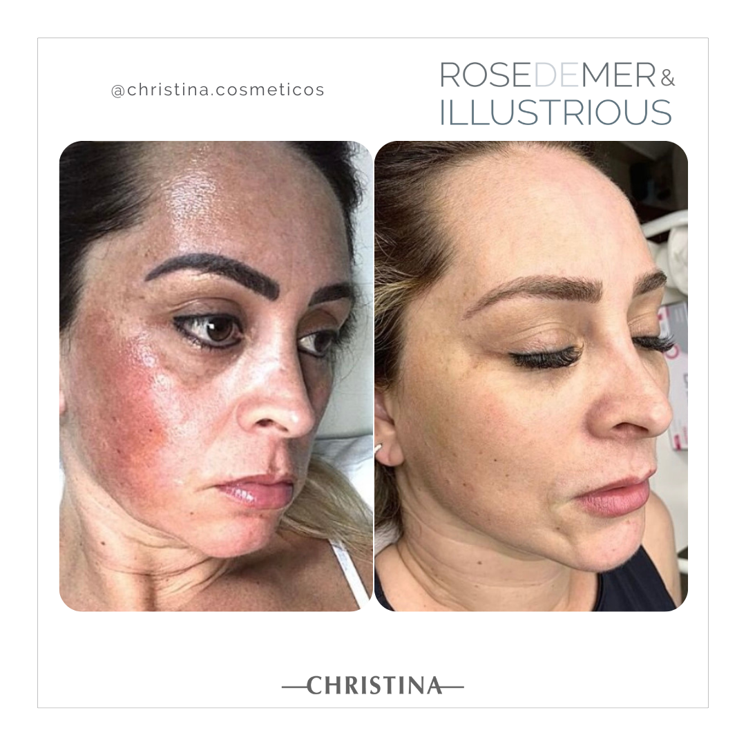 Diferença Entre Clareamento e Uniformização do Tom - inspiração 1