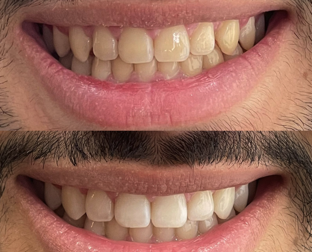 O Papel Fundamental da Proteção Solar no Clareamento - inspiração 2