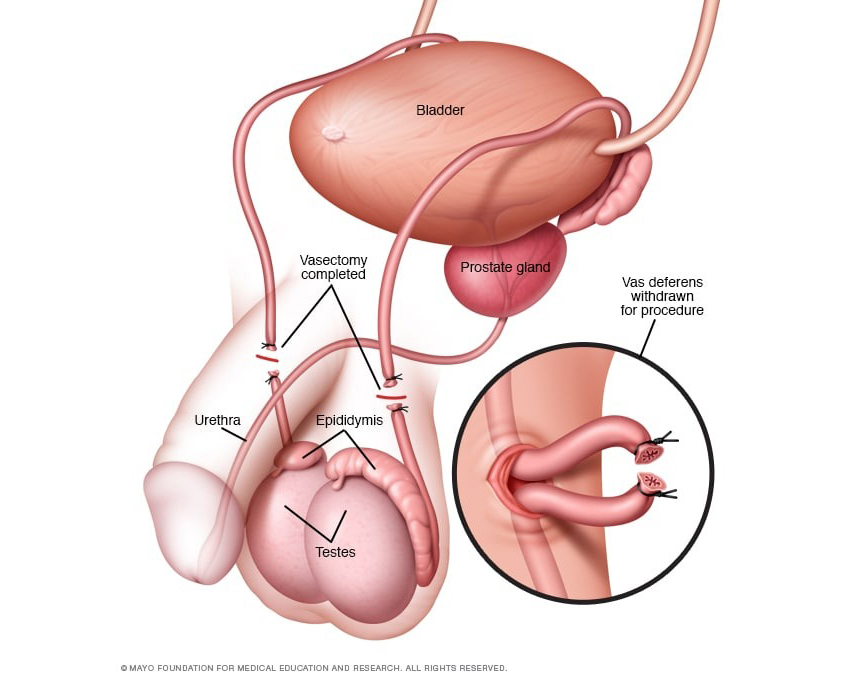 O Que É a Vasectomia e Como Funciona? - inspiração 1