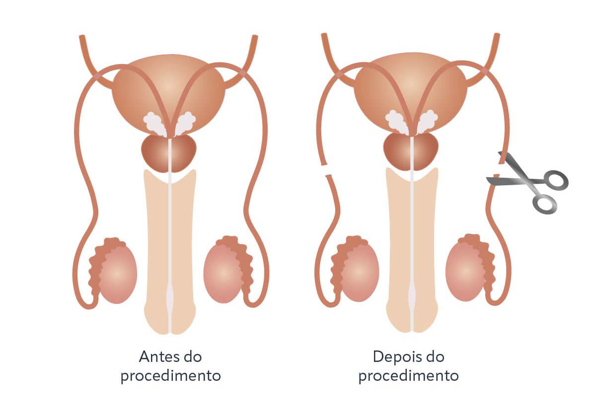 Benefícios e Vantagens da Vasectomia - inspiração 1