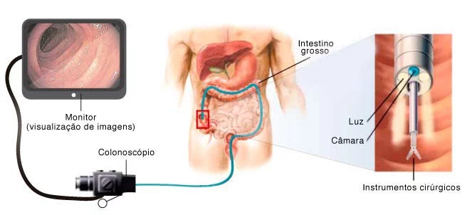 O Que Comer e Beber Antes da Colonoscopia: Dicas da Nutri - inspiração 1