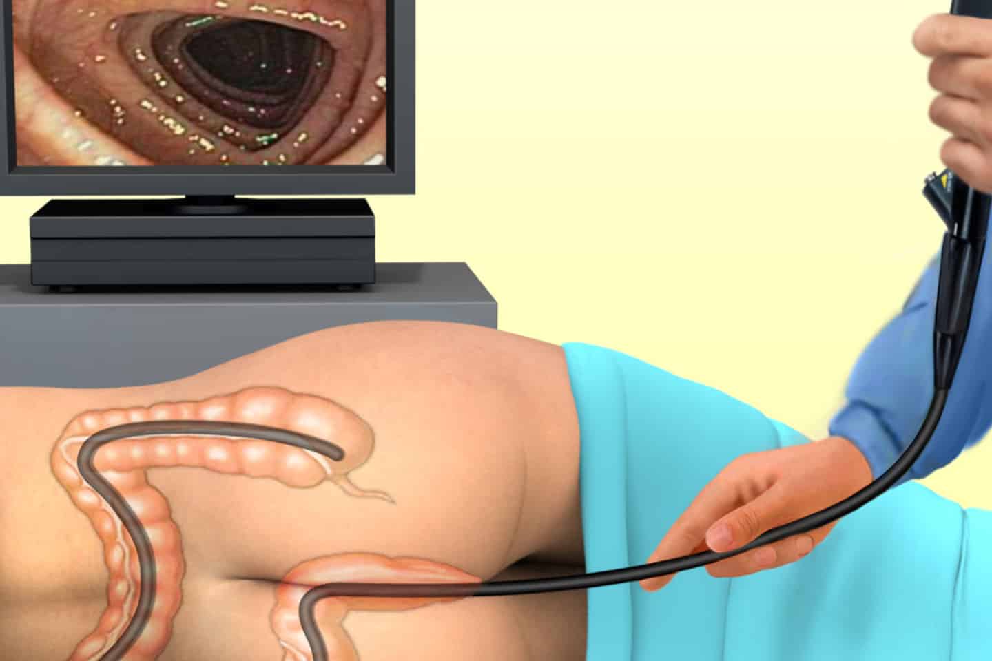 Colonoscopia e Prevenção: Entendendo Seus Riscos - inspiração 2