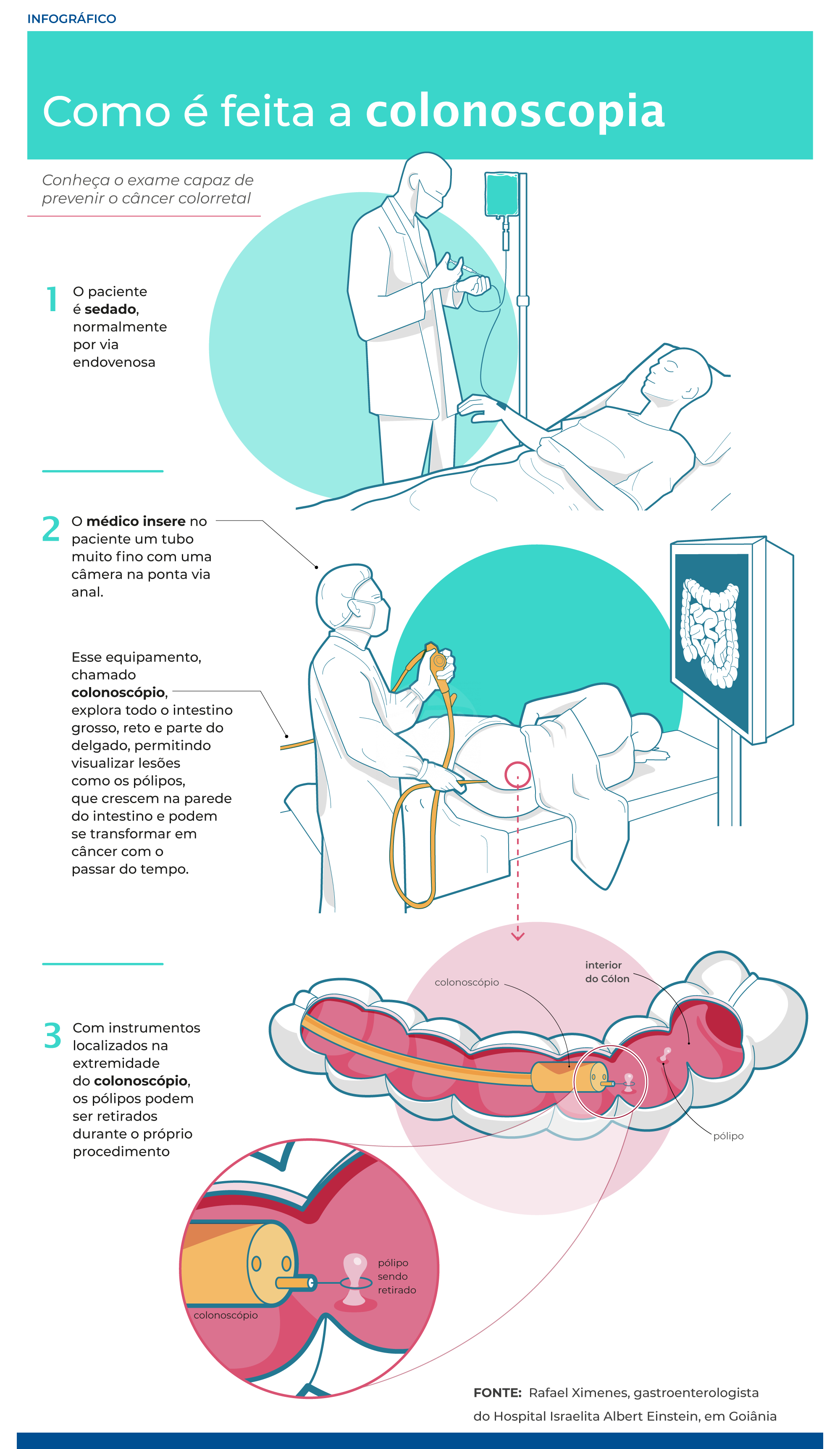 Alternativas à Colonoscopia: Existem Opções? - inspiração 1