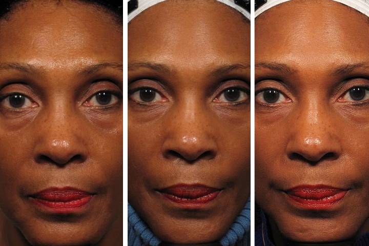 Como funcionam os exercícios faciais para tonificar a pele? - inspiração 2