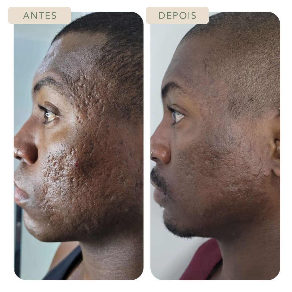 Cuidados Essenciais Pós-Microagulhamento - inspiração 1