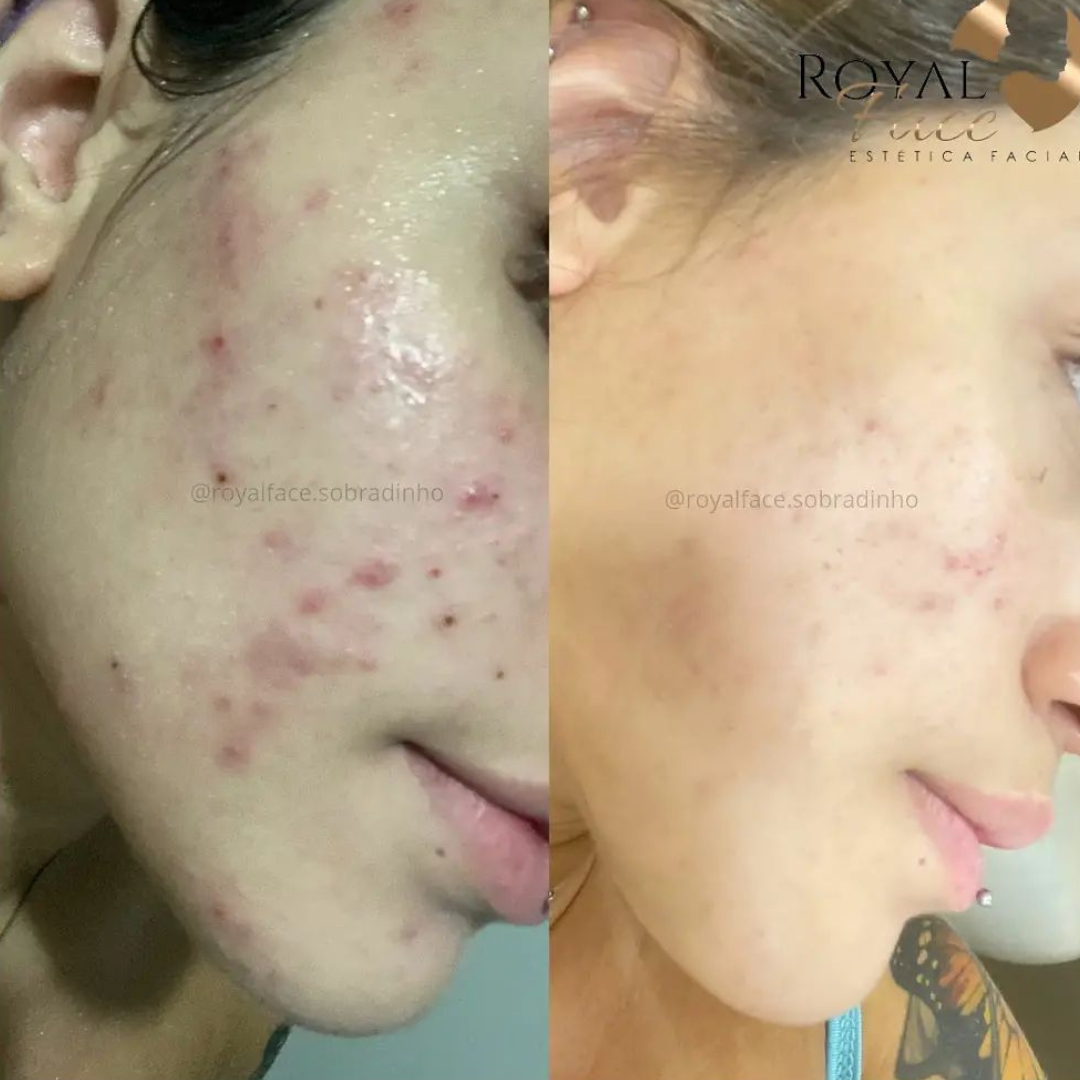 Diferenças Entre Microagulhamento e Outros Tratamentos - inspiração 2
