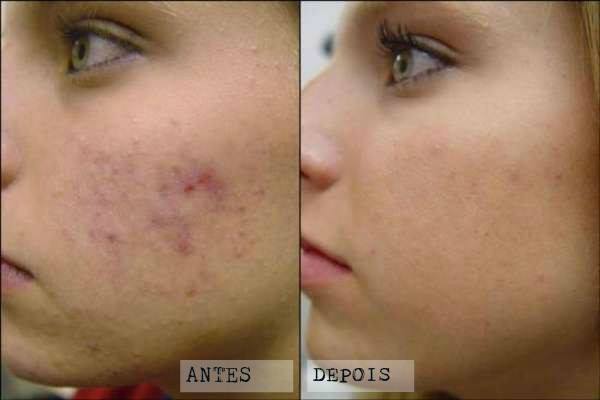 Benefícios Claros da Microdermoabrasão para o Rosto - inspiração 2