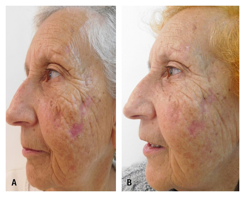 Para quem o peeling com ácidos é indicado? - inspiração 1