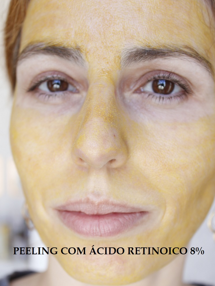 Para quem o peeling com ácidos é indicado? - inspiração 2