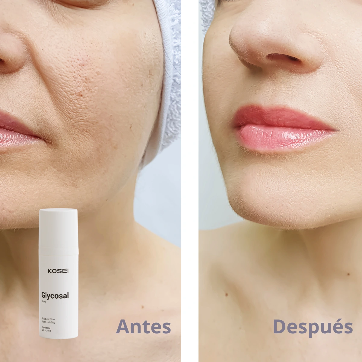 Mitos e verdades sobre o peeling com ácidos: vamos esclarecer tudo! - inspiração 2