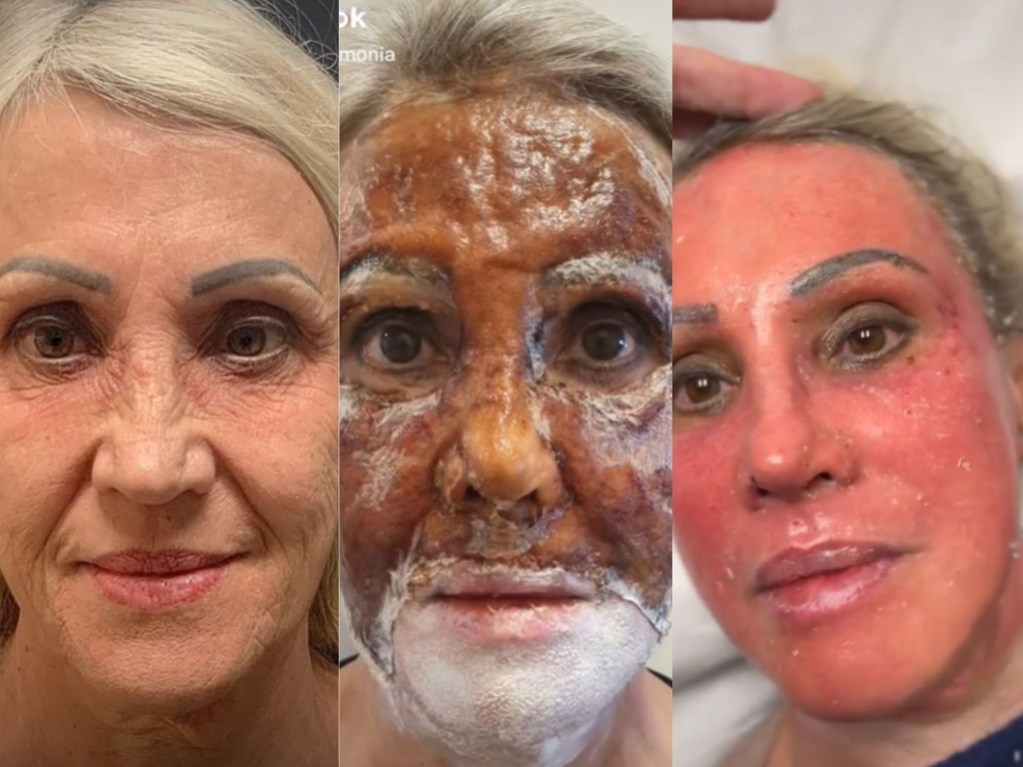 Para Quem é Indicado o Peeling Profundo? - inspiração 1