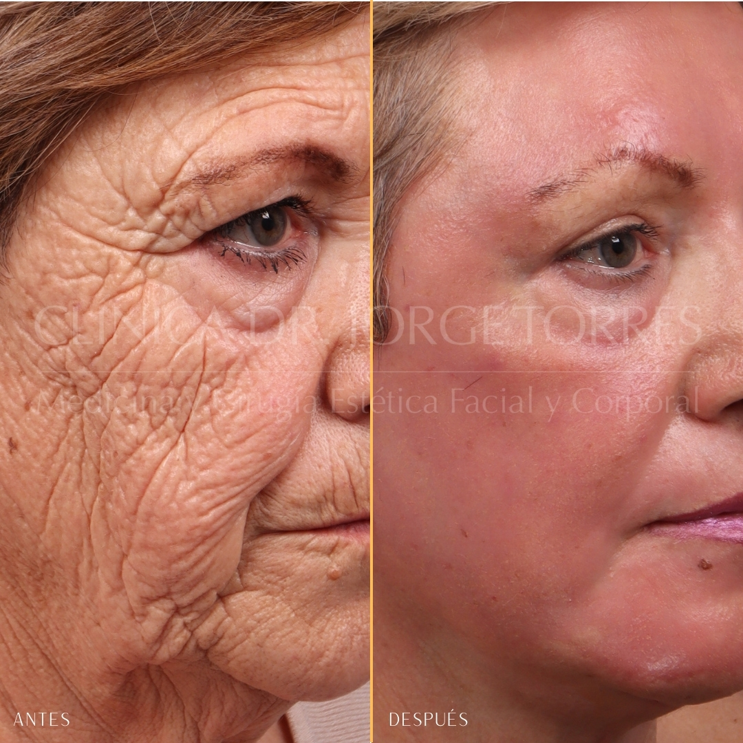 Para Quem é Indicado o Peeling Profundo? - inspiração 2