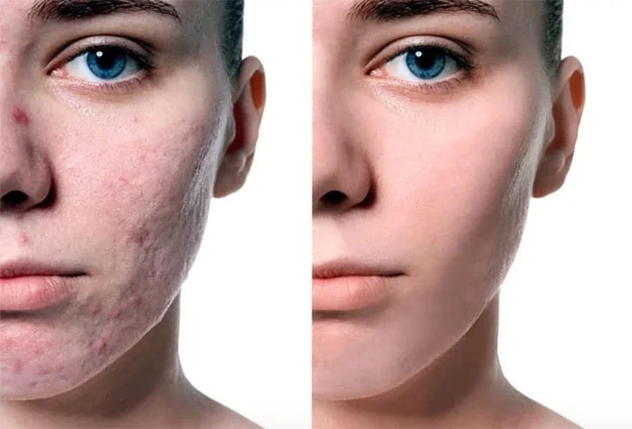 Cuidados Essenciais Pós-Peeling Profundo - inspiração 2