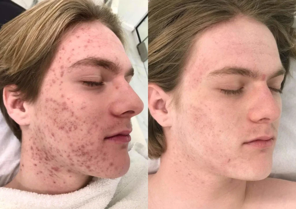 Encontrando o Profissional Certo Para Seu Tratamento de Peeling - inspiração 1