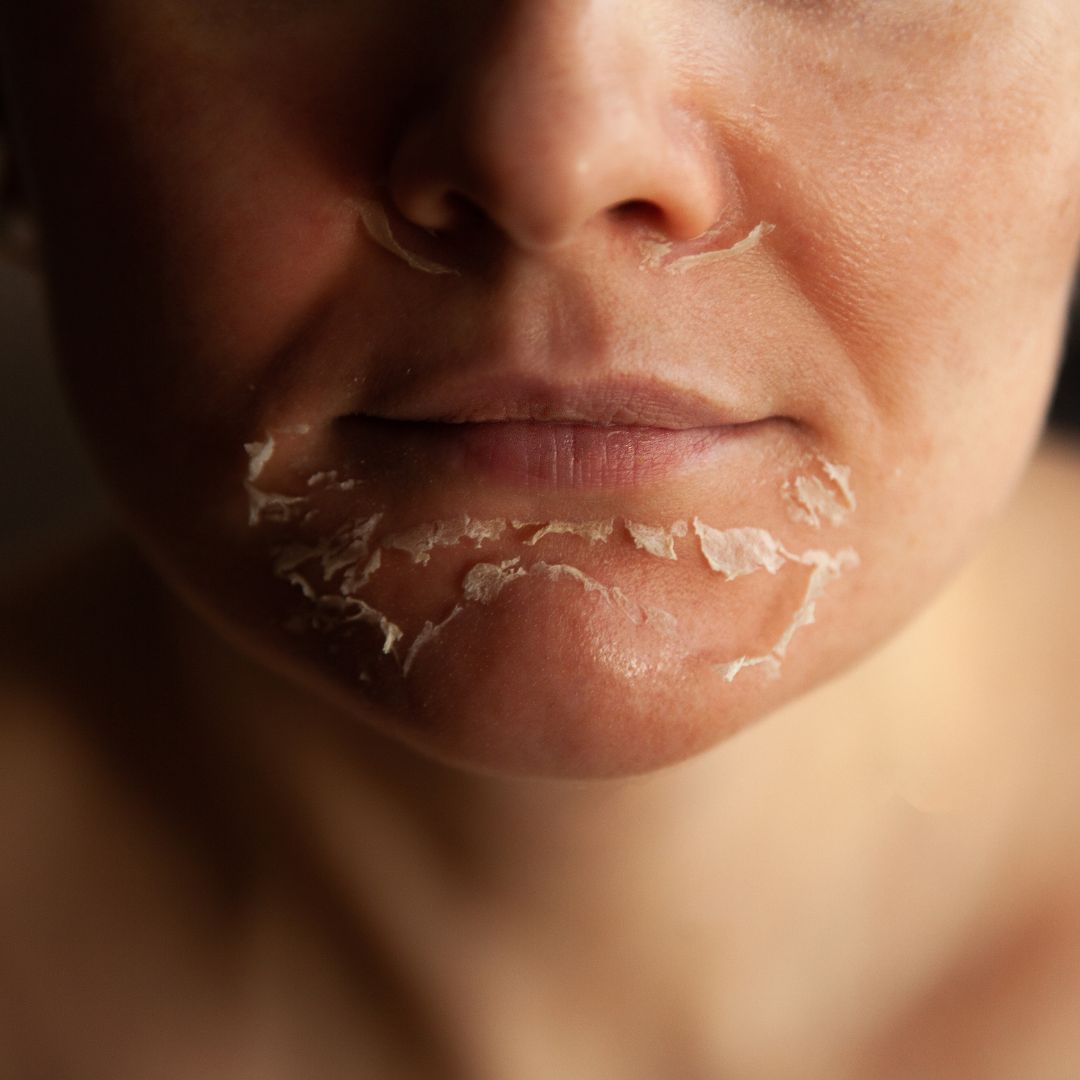 Peelings Químicos e Seus Resultados Visíveis: O Que Esperar? - inspiração 1