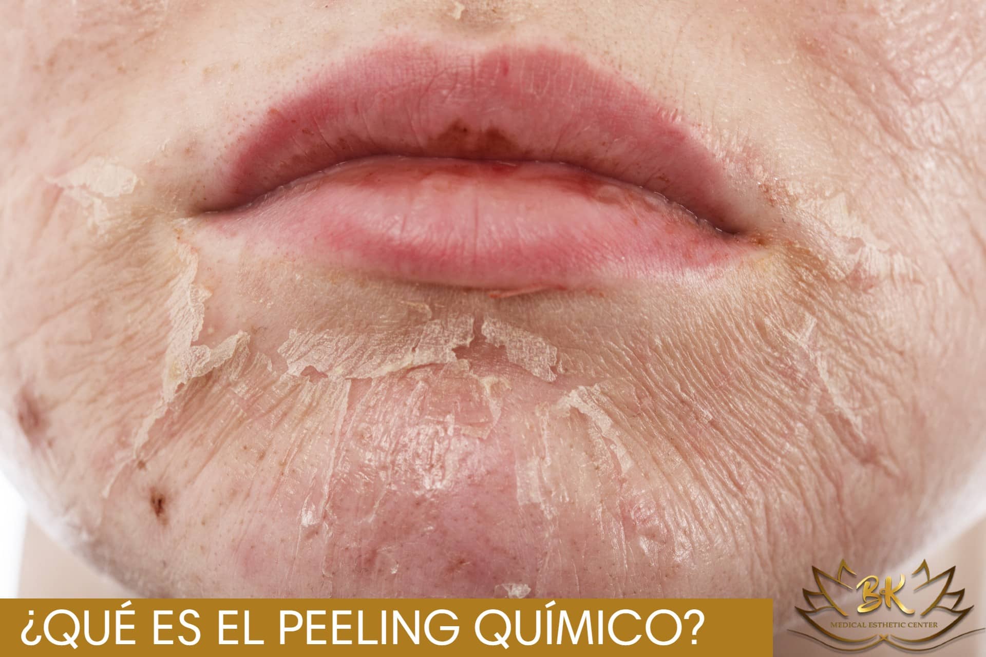 Peelings Químicos e Seus Resultados Visíveis: O Que Esperar? - inspiração 2
