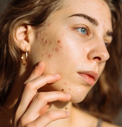 Identificando os Tipos de Acne: Qual o seu caso? - inspiração 1