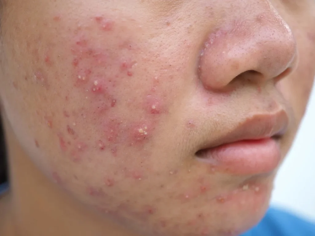 Identificando os Tipos de Acne: Qual o seu caso? - inspiração 2