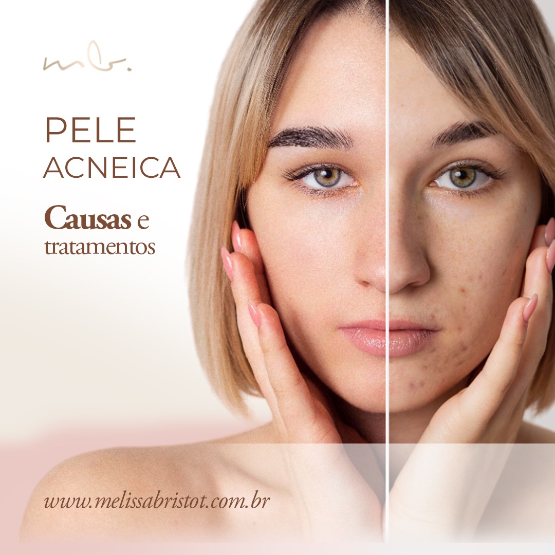 Ciclos Hormonais e Acne: Entendendo as alterações do corpo - inspiração 2