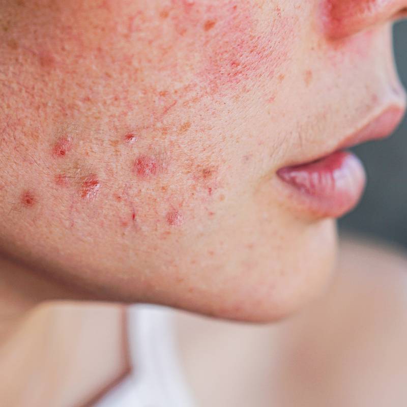 Rotina de Skincare Essencial para Pele Acneica: O básico que funciona - inspiração 2