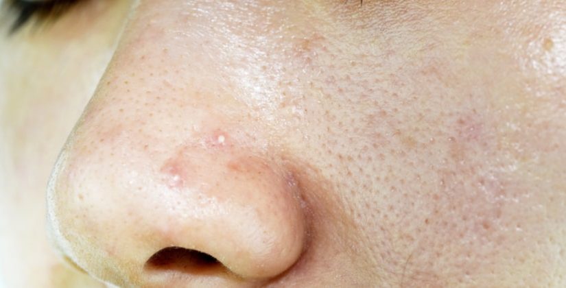 Mitos e Verdades sobre Acne: Desvendando o que realmente importa - inspiração 2