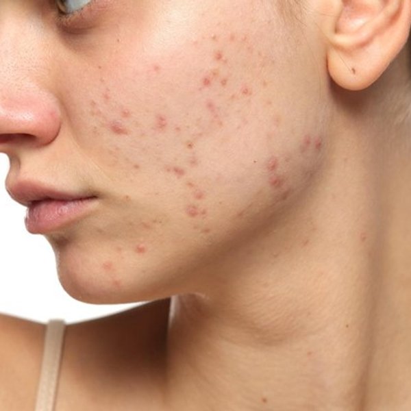 Alimentação e Acne: Uma conexão surpreendente que você precisa saber - inspiração 2