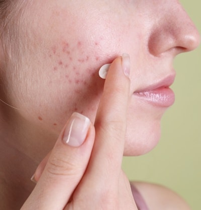 Estresse e Pele Acneica: Como o emocional afeta sua pele - inspiração 1