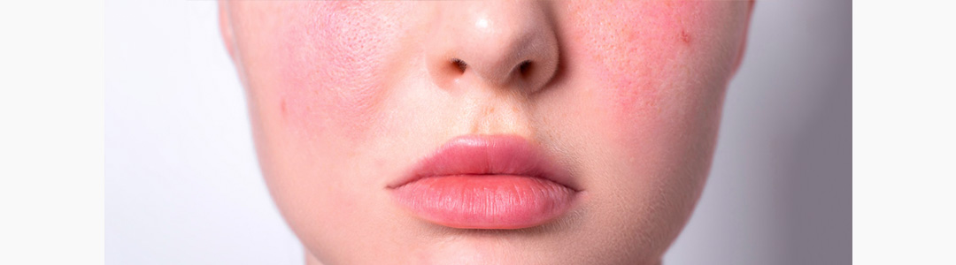 Ressecamento e Descamação: A Barreira Cutânea Comprometida - inspiração 1