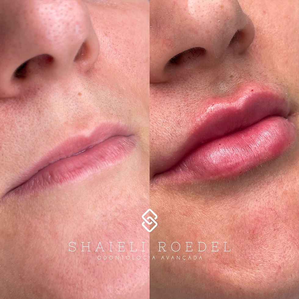 O Que É Exatamente o Preenchimento Natural? - inspiração 2