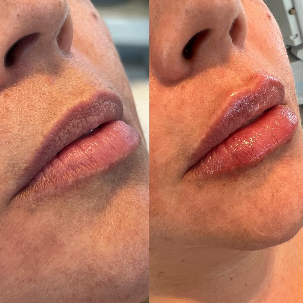 Para Quem é Indicado o Preenchimento Natural? - inspiração 2