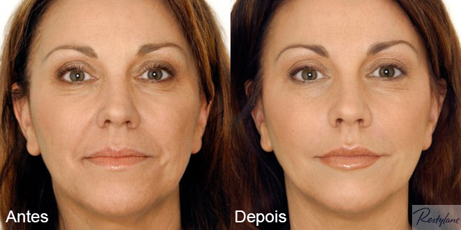 Os Tipos de Substâncias Usadas no Preenchimento Natural - inspiração 1