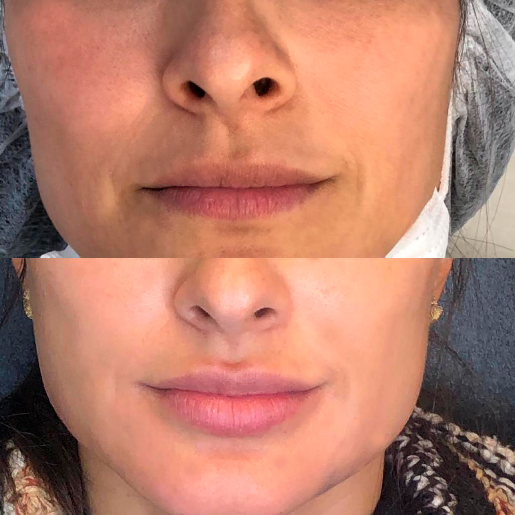 Os Tipos de Substâncias Usadas no Preenchimento Natural - inspiração 2