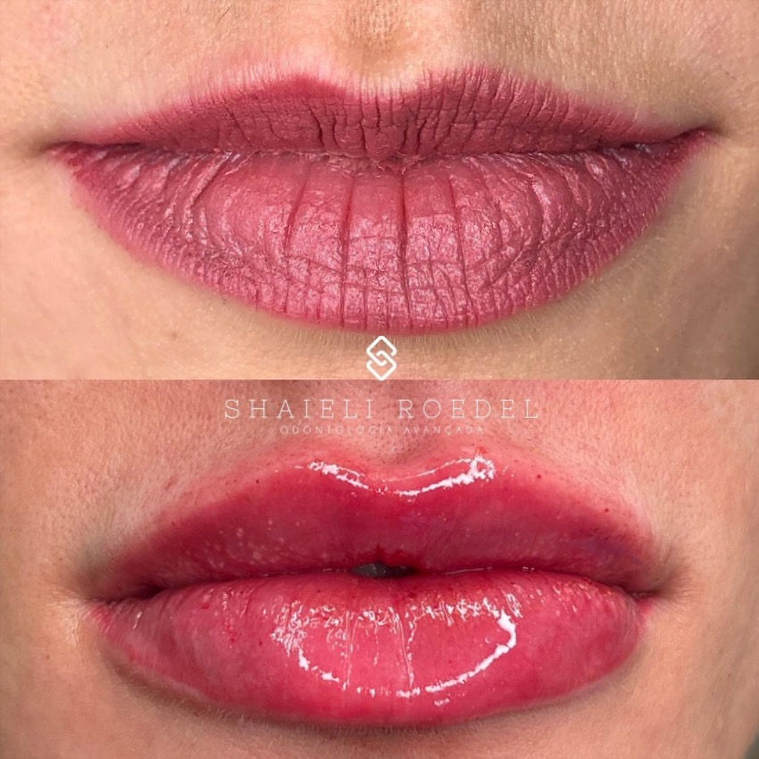 O Procedimento Passo a Passo: Da Consulta à Recuperação - inspiração 2