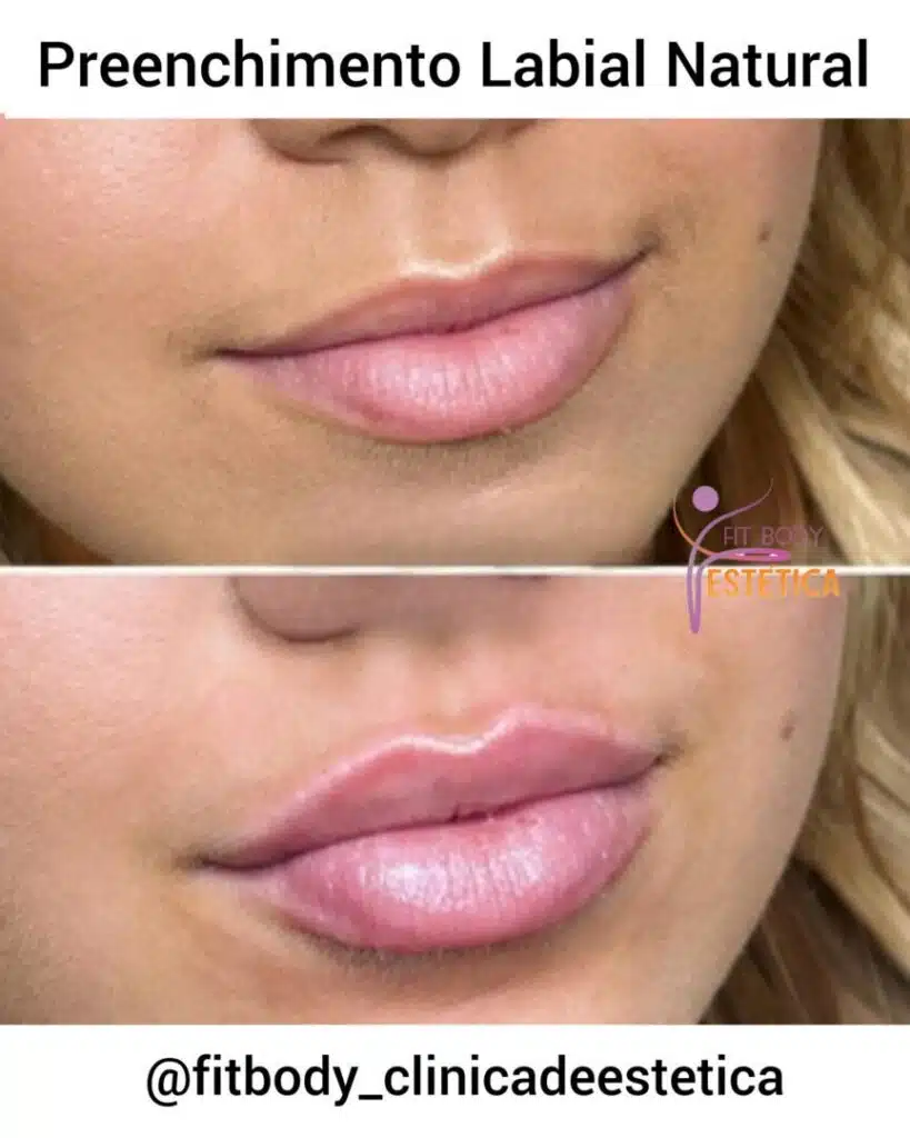 Como Escolher o Profissional Certo Para Seu Preenchimento - inspiração 1