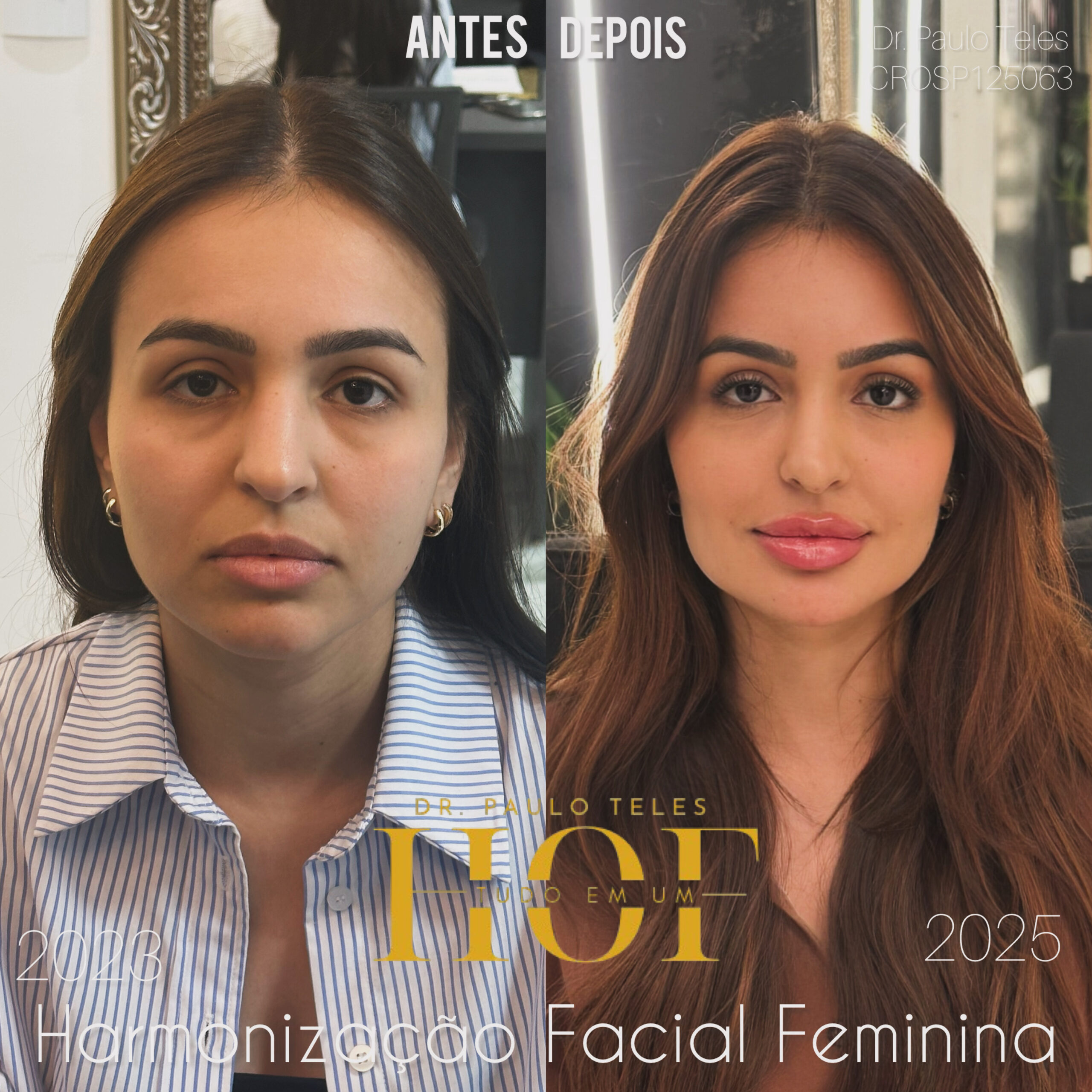 Como Escolher o Profissional Certo Para Seu Preenchimento - inspiração 2