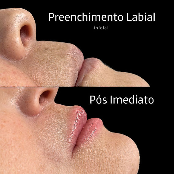 Cuidados Essenciais Pós-Preenchimento Para Longevidade - inspiração 2