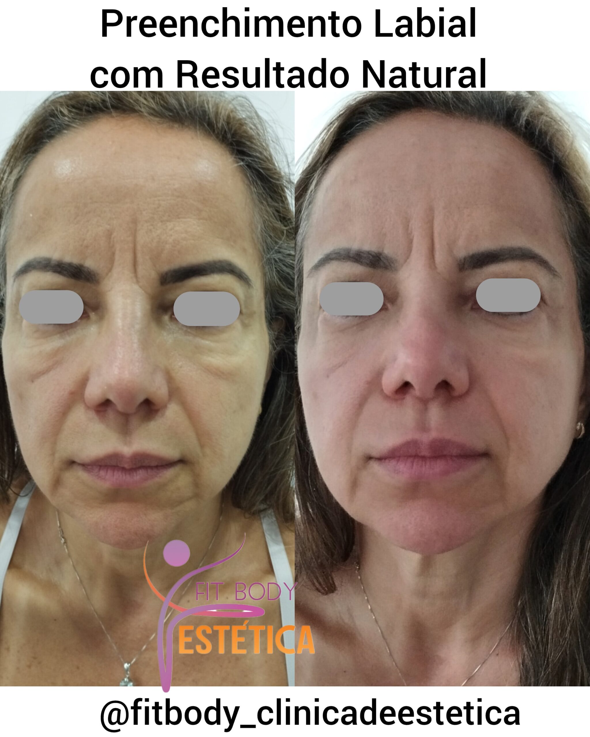 Mitos e Verdades Sobre o Preenchimento Facial Natural - inspiração 2