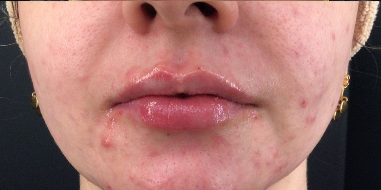 Preenchimento Natural vs. Cirurgia: Qual a Diferença? - inspiração 2