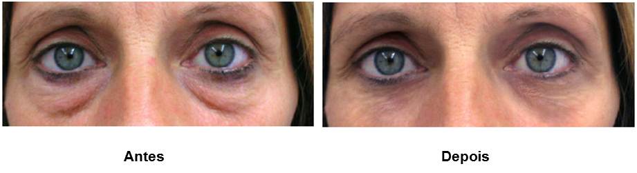 O Poder dos Peptídeos e Vitamina C no Combate às Olheiras - inspiração 2