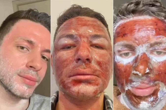 Ácido Hialurônico: O Hidratante Poderoso para sua Pele - inspiração 2