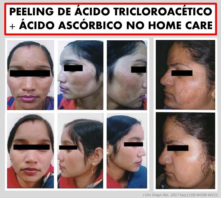 Ácido Salicílico: Seu Aliado Contra Acne e Poros Dilatados - inspiração 2