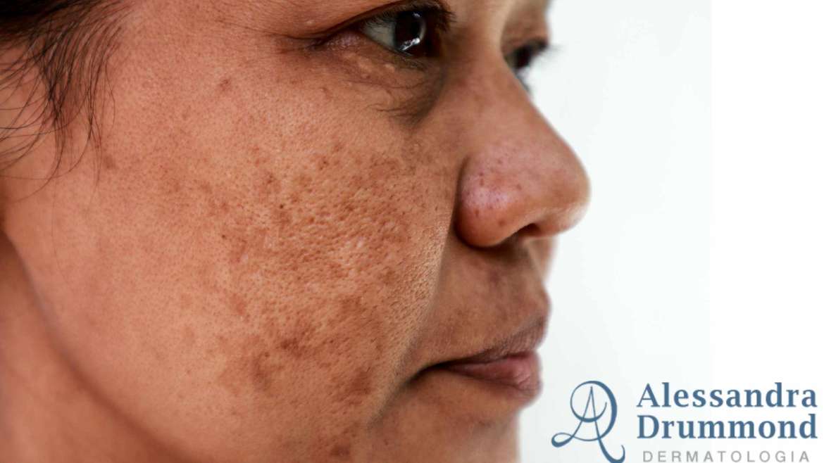 Ácido Lático: Um Toque Delicado de Renovação Celular - inspiração 2