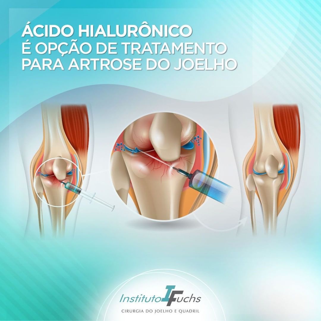 Entendendo a Anatomia do Joelho: Por Que Ele é Tão Importante? - inspiração 1