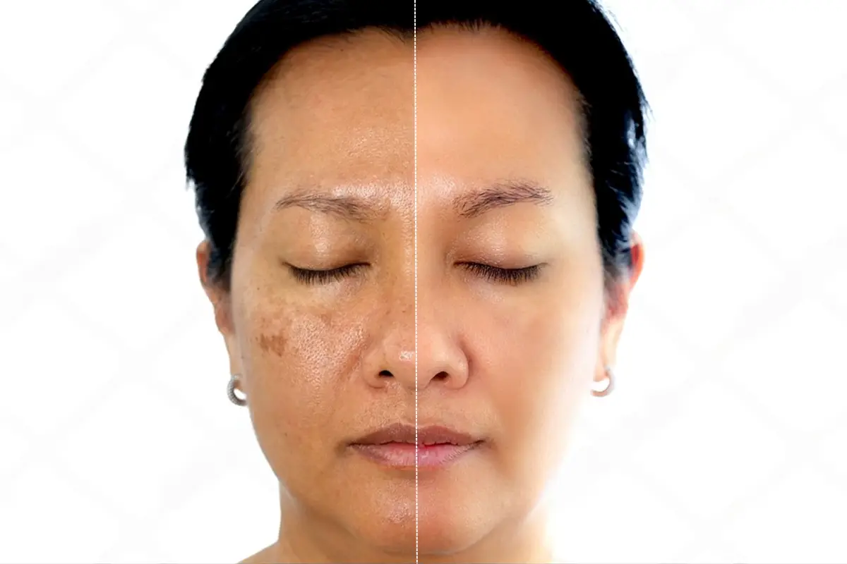 Entendendo o Melasma: O Que Você Precisa Saber - inspiração 1