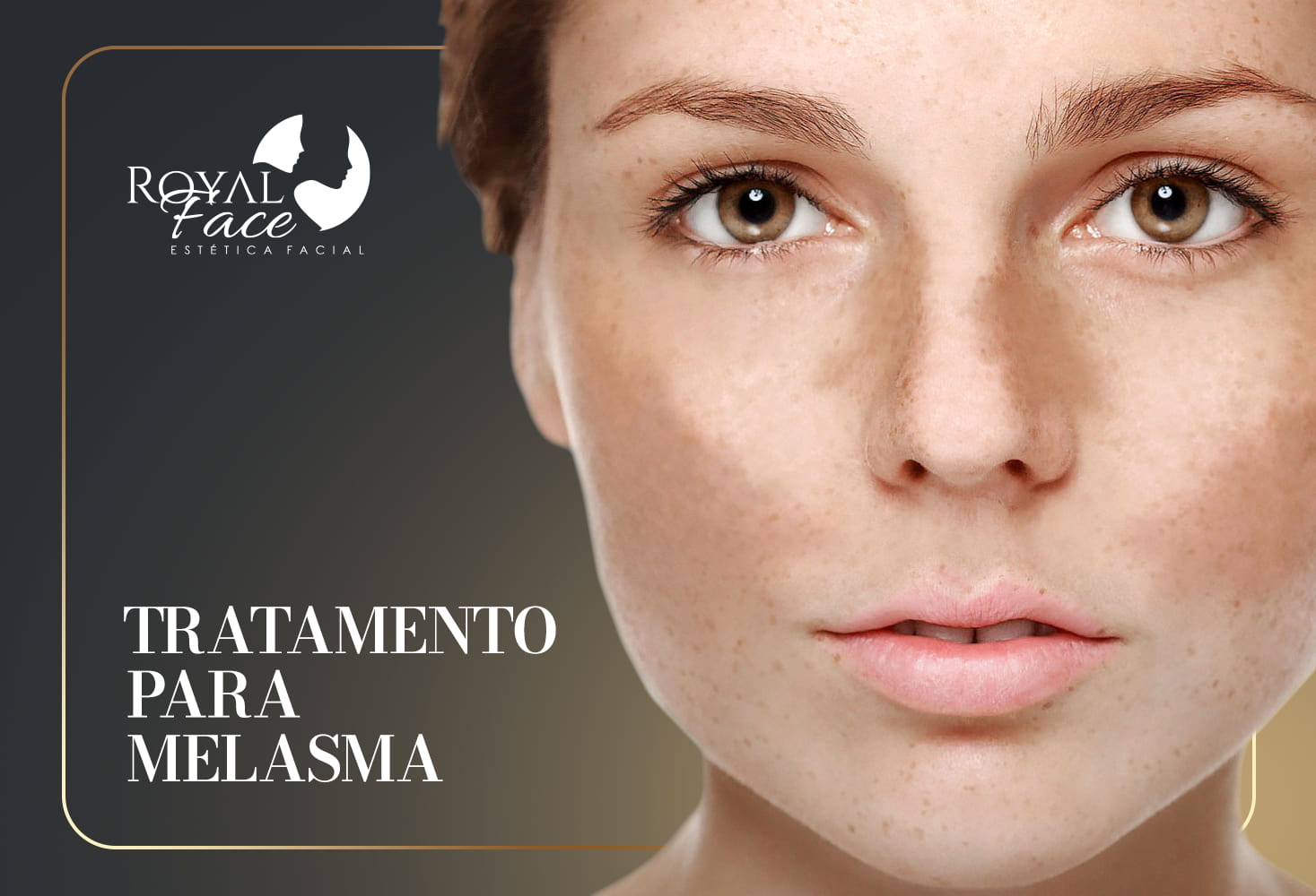 Entendendo o Melasma: O Que Você Precisa Saber - inspiração 2