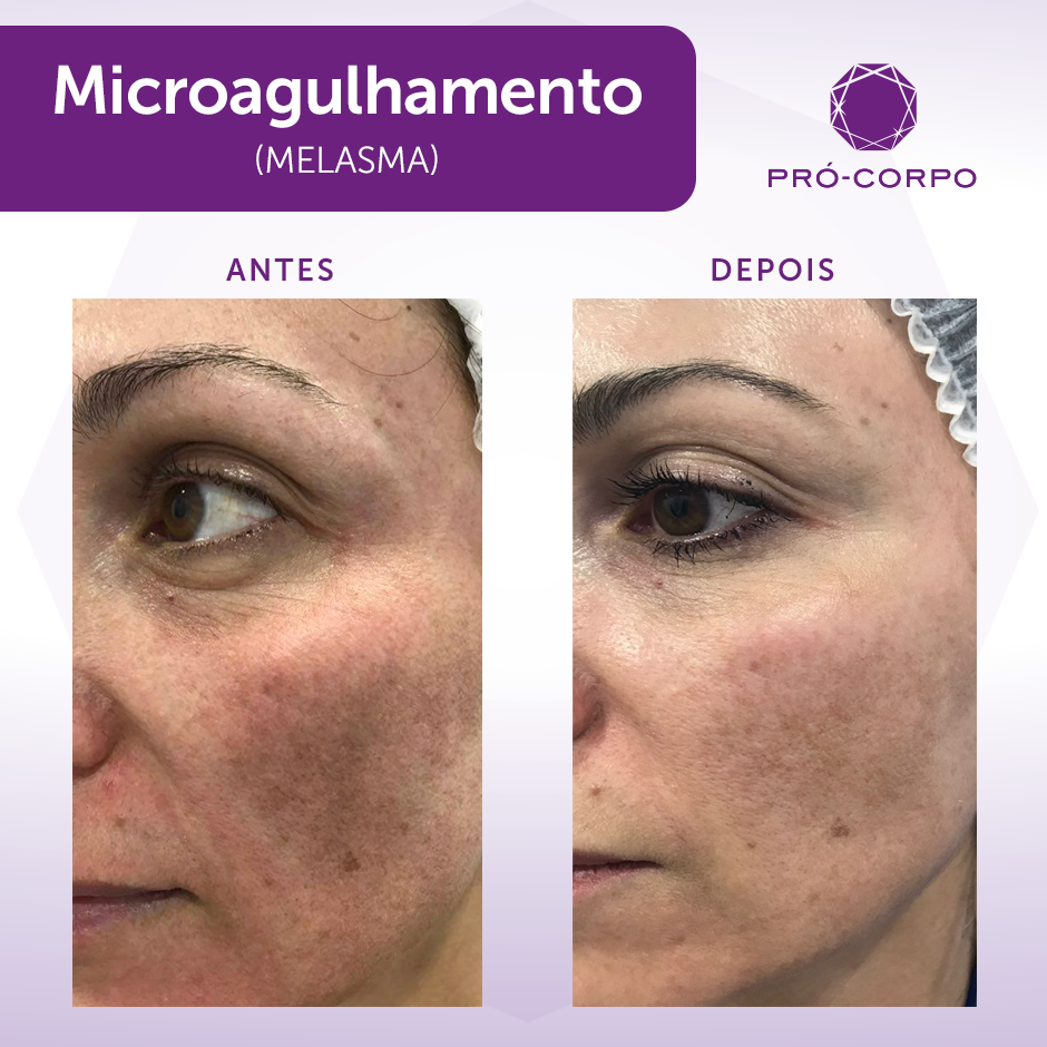 Diferentes Tipos de Melasma e Como Identificá-los - inspiração 2
