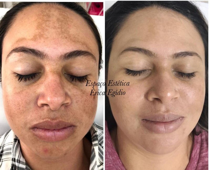 Tratamentos Tópicos: Cremes Que Fazem a Diferença - inspiração 1