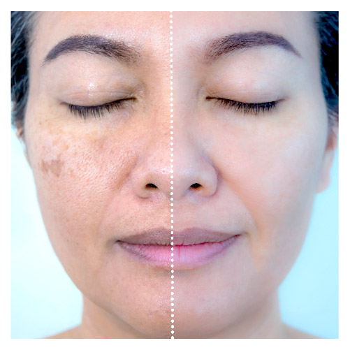 Procedimentos Estéticos: Aliados Poderosos no Combate às Manchas - inspiração 1