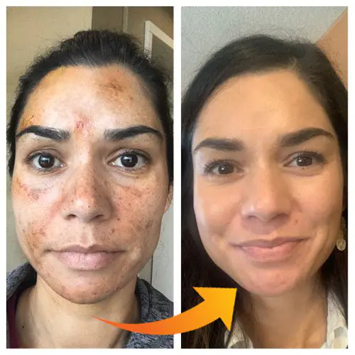 Evitando Gatilhos: O Que Pode Piorar Suas Manchas - inspiração 1